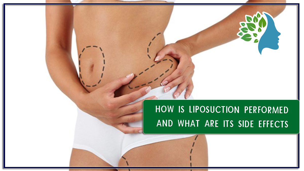 How is liposuction performed and what are its side effects