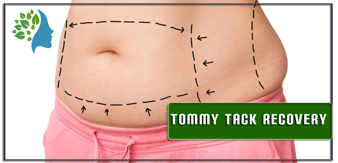 Tummy Tack Recovery: Duration, Tips, and More